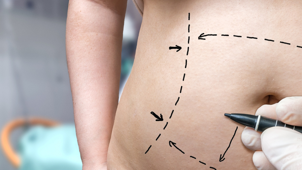 Plastic Surgery Dubai 