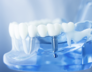 Dental Implants Dubai