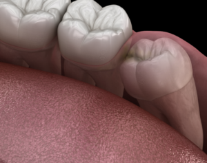 Wisdon Teeth Removal