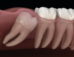 wisdom teeth removal Dubai