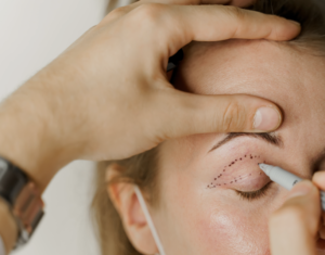 Blepharoplasty Dubai