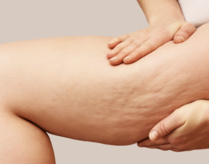 Liposuction in Dubai