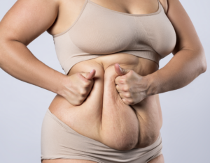 Liposuction in Dubai