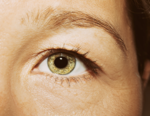 Blepharoplasty Dubai