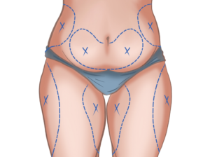 Liposuction in Dubai
