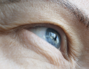 Blepharoplasty Dubai