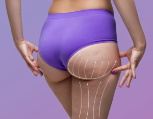 Liposuction in Dubai